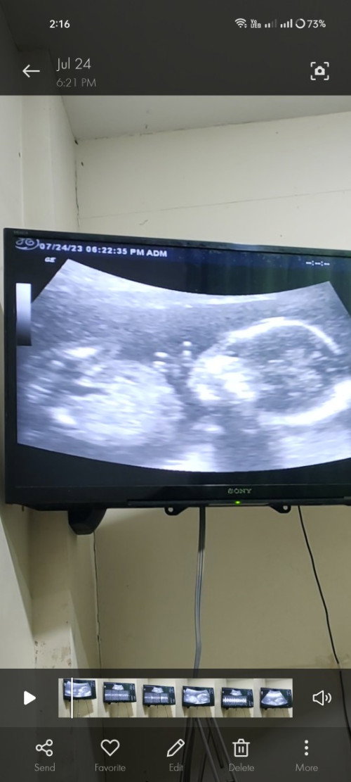 Girl or boy? Sa tingin nyo po? 
Next month pa po ang gender reveal but I can't wait 😁