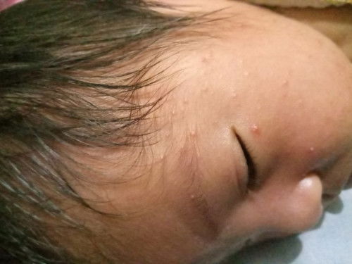 Jerawat/bruntus di pipi