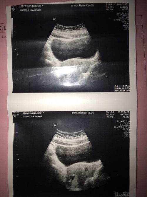 flek coklat di hamil muda