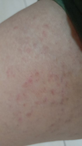 31 week gatal gatal merah begini bun‽