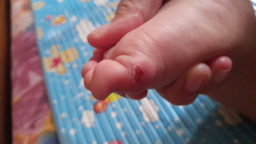 Luka anak pada jari kaki anak