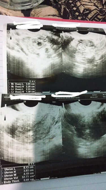 USG 7w masih penebalan dinding rahim