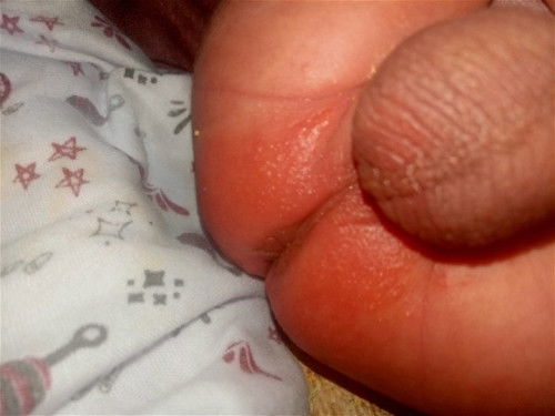 Pantat bayi kemerahan