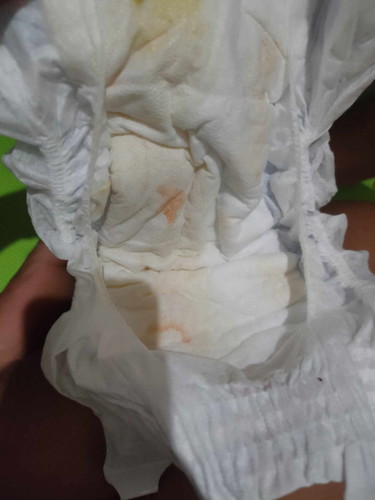 ano po kaya itong stain na kasama sa ihi ng newborn baby boy ko?