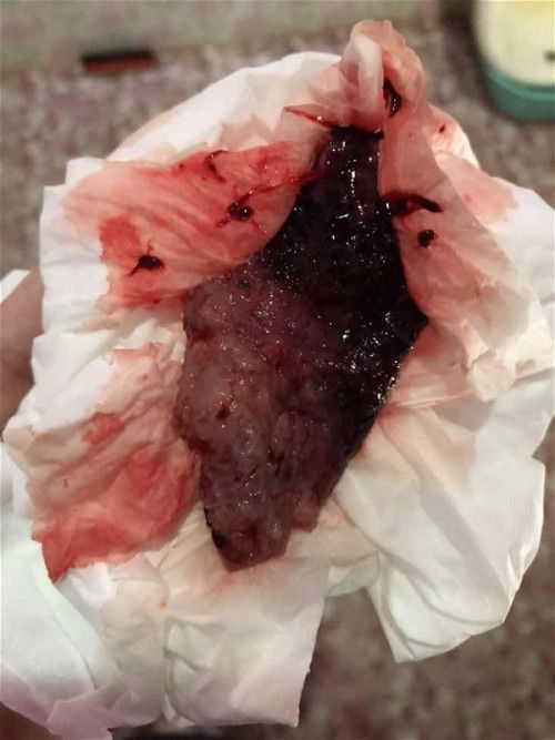 เป็นประจำเดือนกระปิดกระปอยแล้วมีก้อนหลุดออกมา