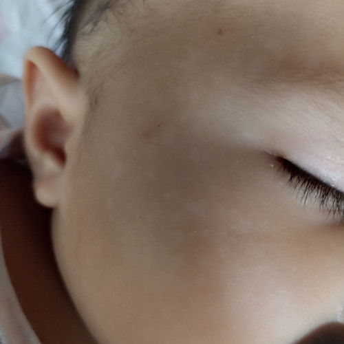 Pahelp po, no budget for derma