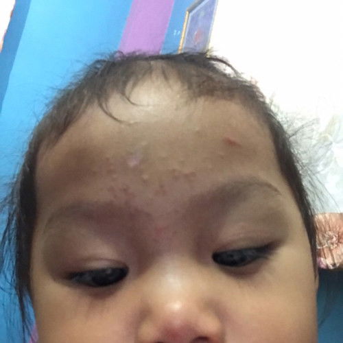 #คุณแม่ๆช่วยแนะนำหน่อยค่ะ  น้องเป็นผื่นแบบนี้รักษาไม่ดีขึ้นเลยค่ะ มีแม่ๆคนมีประสบการณ์บ้างไหมค่ะแนะนำทีค่ะ #ขอบคุณล่วงหน้านะคะ