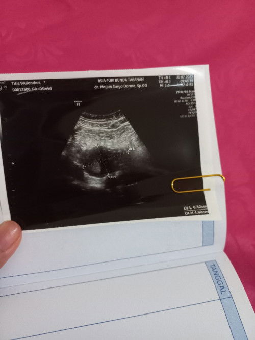 Bun ada yang samaan ngga?
5w4d belum keliatan kantung janin?