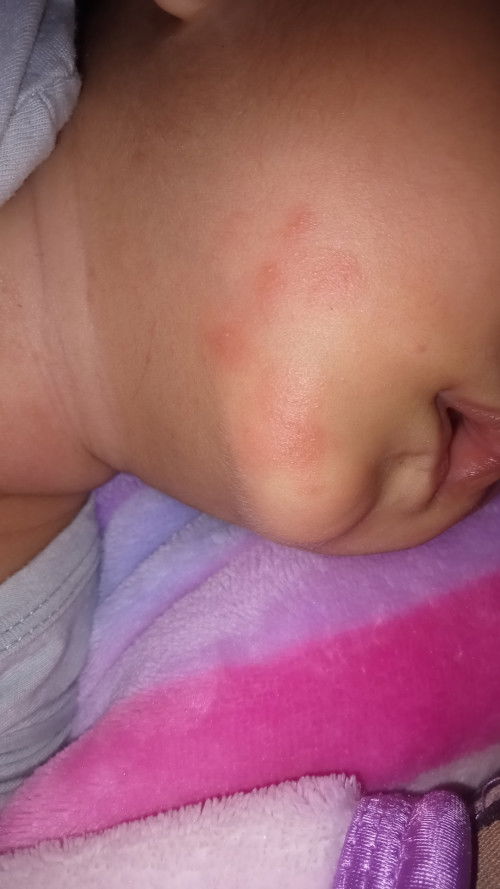 ผื่นหรือแพ้ยาคะแบบนี้