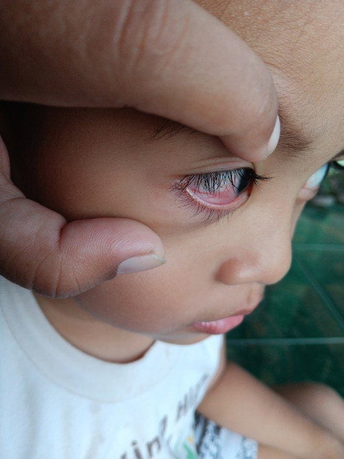 Lapisan putih mata anak berwarna merah