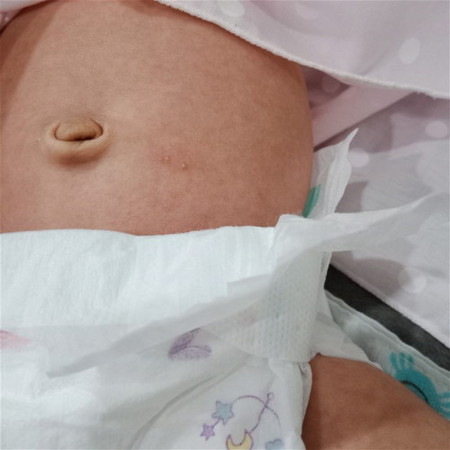 ลูกมีตุ่มขึ้นที่ท้อง