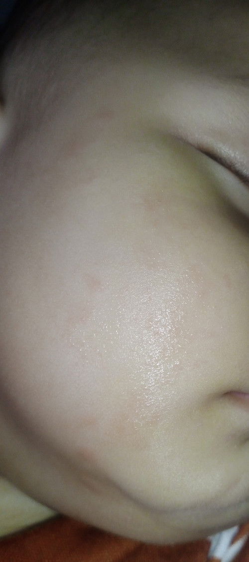 Bentol² merah di pipi bayi