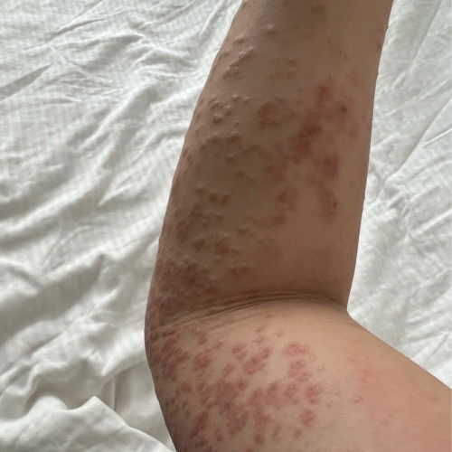 Pupps rash or Pemphigoid gestationis