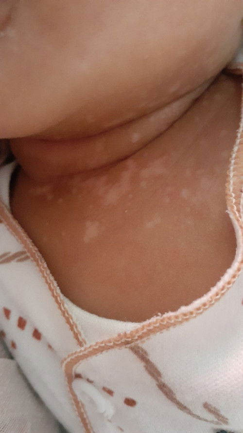 Kulit bayi banyak bercah putih