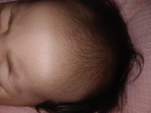 Worried po ako sa ulo ng baby ko. wala pa rin kasing buhok sa may bandang taas ng noo. 6months old