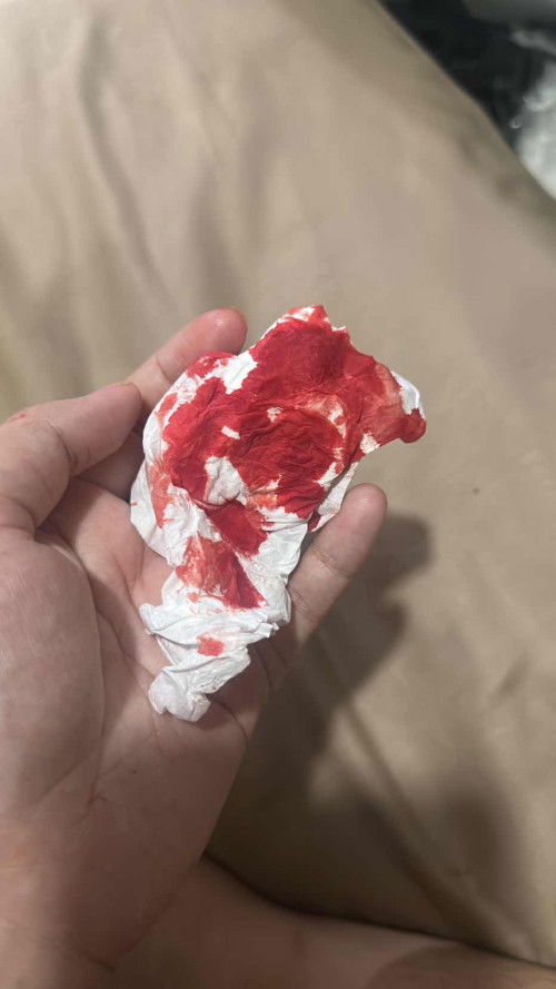 Sakit kepala dan mimisan