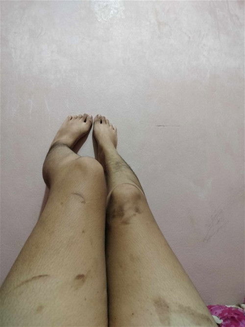 รอยจ้ำเลือดแบบนี้ปกติไหมคะ  มีจุดเล็กๆเหมือนโดนเข็มด้วยค่ะ