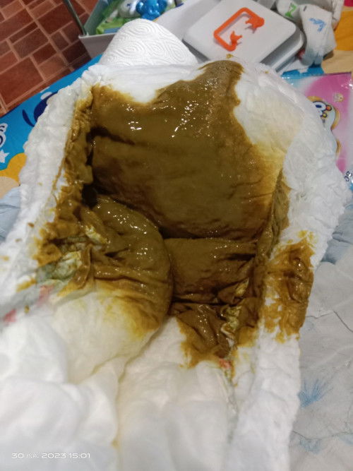 ถ่ายอุจจาระสีเขียว