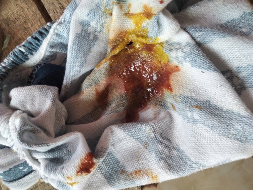 Bab berlendir dan berdarah pada bayi 7 bulan