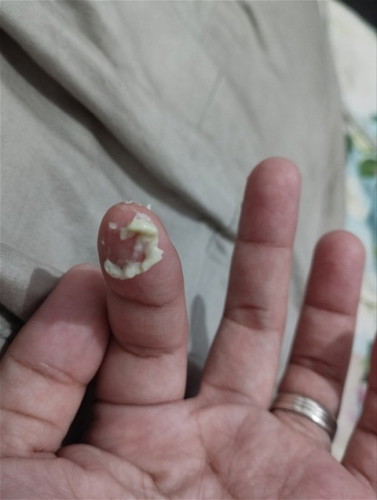 Makapal na White Discharge
