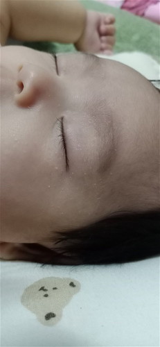 เปลือกตาลอกเป็นคุยๆ