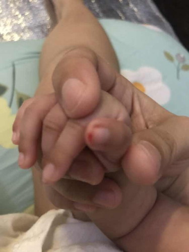 Nagupit ang kuko at nasugatan