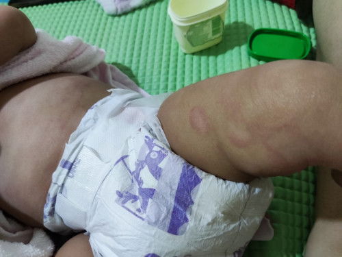 Sesapa ada pengalaman Anak alami ruam di badan.