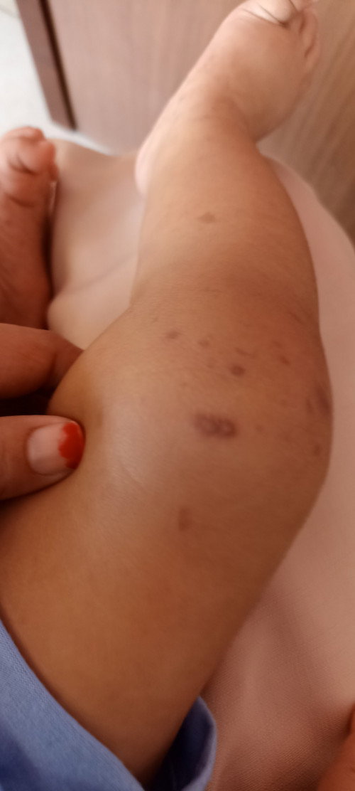 Bun salep apa ni yg bgus buat hlngin bekas gatal buat bayi 7 bln