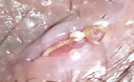 สอบถามค่ะแม่ๆ แผลคลอดธรรมชาติ