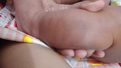 Kulit kering . Ruam pada bayi