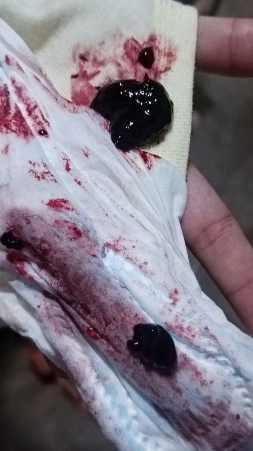 Postpartum Discharge