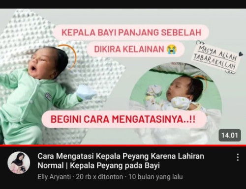 Bun adalah anaknya yg lahir normal tersendat trs kepalanya lonjong, kira2 diusia brp ya normal kmbli