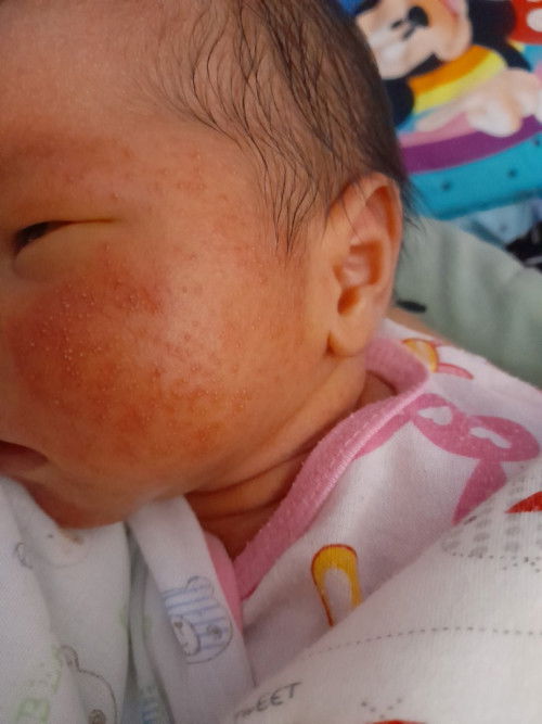 เเรกเกิด เป็นผดผื่นที่หน้า คอ