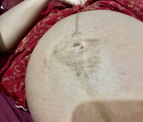 Gatal disekitar pusar