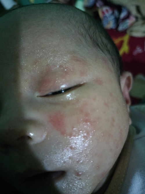 Kulit bayi bintik merah