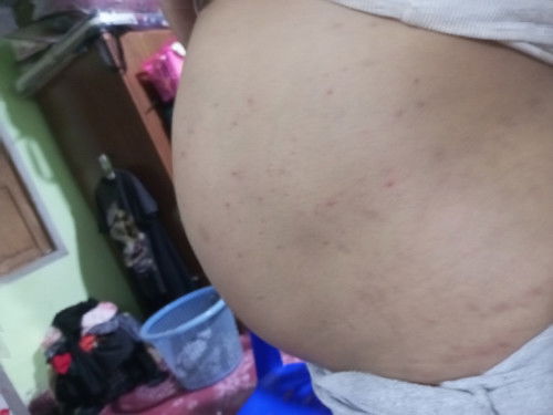 ผื่นคันหนักมากกกก