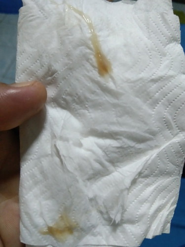 ขอคำปรึกษาหน่อยคะแม่มีแบบนี้ออกมาแล้วปวดหลังหน่วงๆหนักๆ