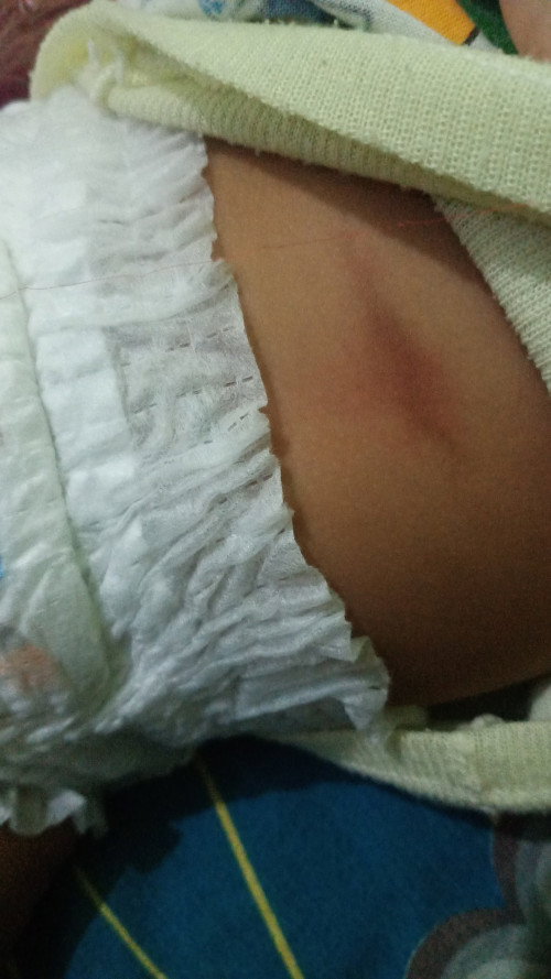 Perut ank saya kok merah bun, di atas nya puser nya bun, itu kenpa ya bun