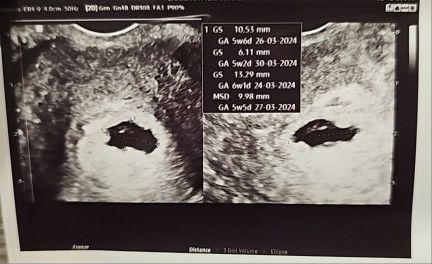 Irregular Gestational Sac