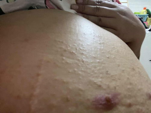 มีผื่นขึ้นคันที่ท้อง