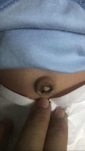 tali pusat