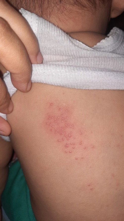 Merah pada punggung anak