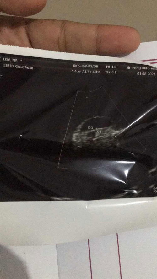 Dinyatakan Hamil tidak berkembang