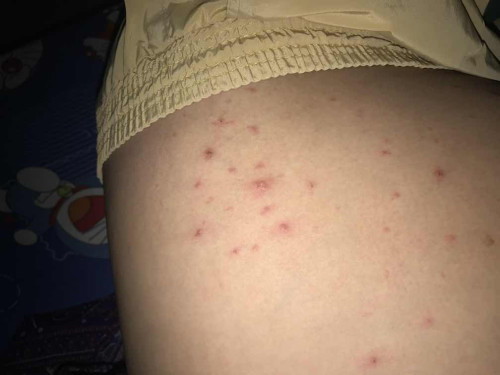 ผื่นนี้เกิดจากอะไร อันตรายไหม