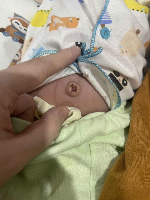 Granuloma umbilikalis