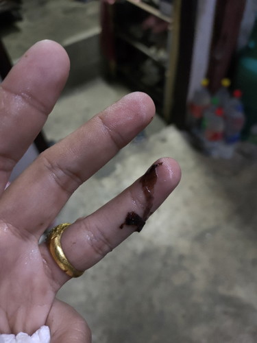 ท้อง12วีคมีเลือดออก