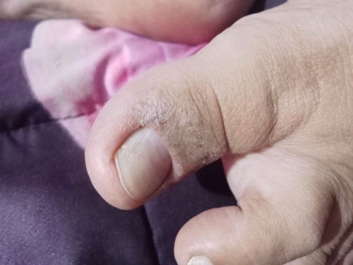 Bunda ada yg lg hamil muncul gatel2 gtu gak srg ak garuk smpe keluar nanah obatny apa yah?