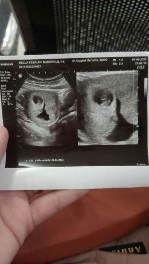 Hamil 6 Minggu, sudah ada janin tapi di sebelah janin ada darah yang lumayan bnyak