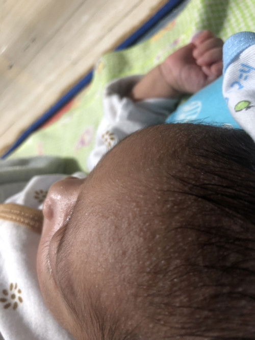 Bruntusan di kepala bayi