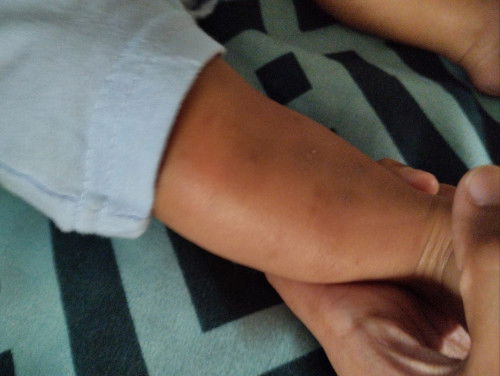 Hitam hitam bekas gigitan nyamuk